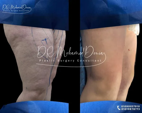 img of استمتعى بجسم مشدود من غير سليوليت
